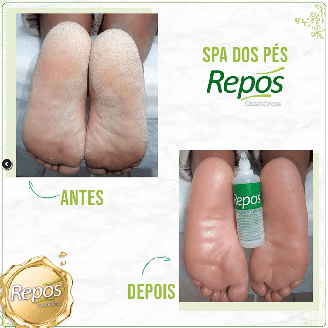 Amaciante Cutículas Calosidade Líquido Repos 150ml (30ml Gratis)